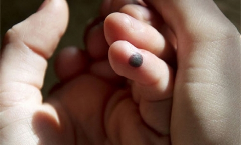 علاجات منزلية فعالة للتخلص من البثور الدموية بالجلد