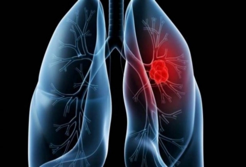 كشف لغز إصابة غير المدخنين بمرض رئوي مزمن