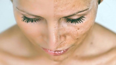 كيف تتخلصين من البقع السوداء والداكنة على بشرتك؟