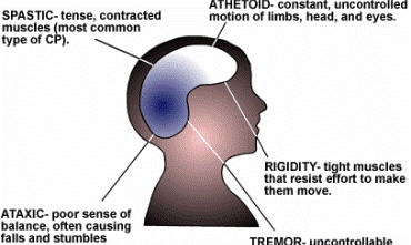 Derman ji nexweşiya felca mejî re hate dîtin