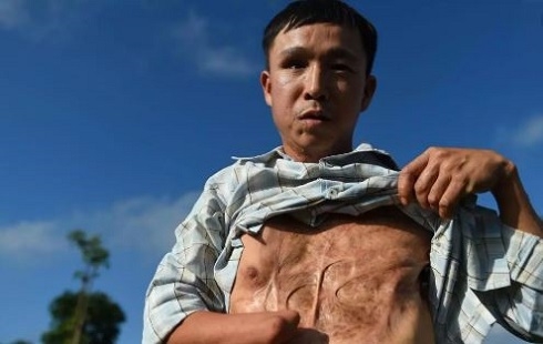 Trump lifts US restrictions on anti-personnel landmines