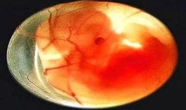 Mûsil: Zarokekî biçûk di zikê keçeka 2 salî de bû