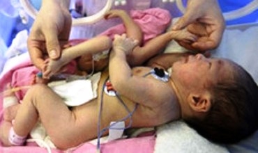 Li Çînê zarokekî bi 8 ling û destan ji dayîk bû