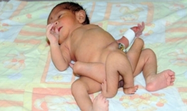 Ev zarok bi 6 piyan jidayîk bû