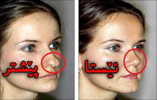 بەبێ نەشتەرگەری لووتتان جوان بكەن