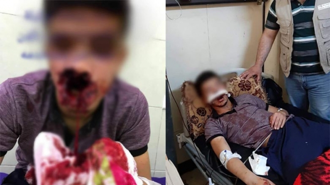تەقینەوەی جگەرەیەکی ئەلیکترۆنی گەنجێك بەسەختی بریندار دەکات
