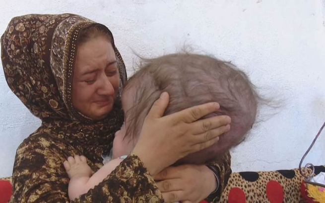 منداڵێک بەهۆی نەخۆشییەکی زگماکییەوە سەری دوو هێندەی جەستەیی لێهاتووە