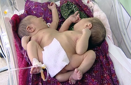 سلێمانی.. دوو منداڵە پێکەوە لکاوەکە بەمەبەستی چارەسەرکردن‌ بەرەو تاران بەڕێدەخرێن