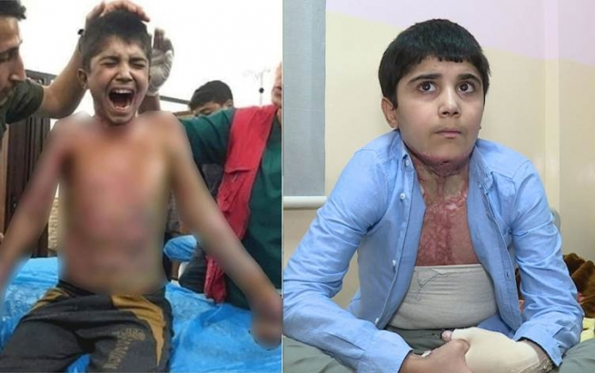 ئەو منداڵەی هاواری سووتانەکەی هەمووانی هەژاند، برینەکانی چاک بوونەتەوە