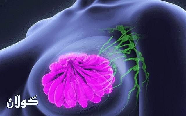  راپۆرتێكی پزیشكی: توشبون بە شێرپەنجەی مەمک لە کۆرۆنا زیاتربوە 