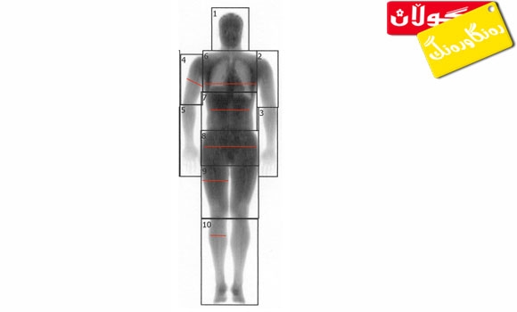 جەڵتەی مێشك