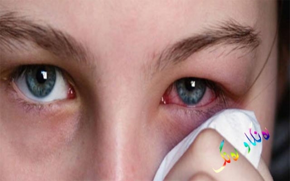 سووربوونەوەی چاو چ كاتێك  پێویستی بە سەردانی دكتۆر هەیە؟