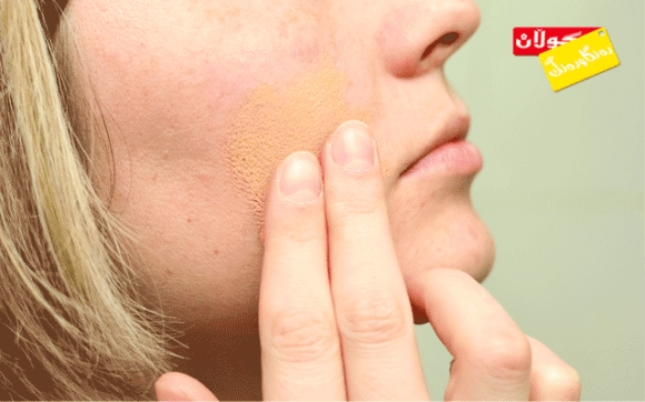 وشكبوونی پێست لۆچبوون تاو دەدات