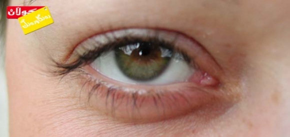 ئاوسانی پێڵووی چاو