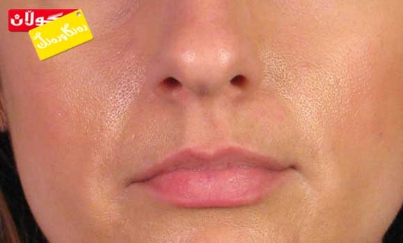 ئاوسانی لێوەكان