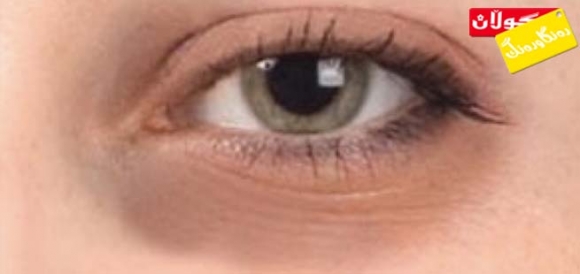 چۆن تاریكبوونی پێستی دەوری چاو چارەسەر دەكرێت؟