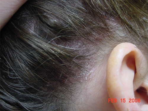 هۆكاری كرێژی سەر