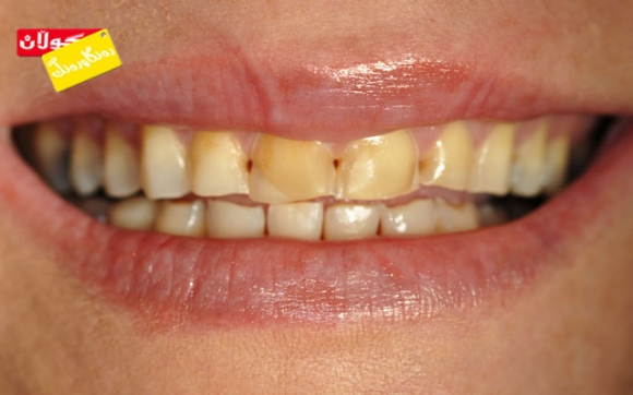 هۆكاری زەردبوونی ددان