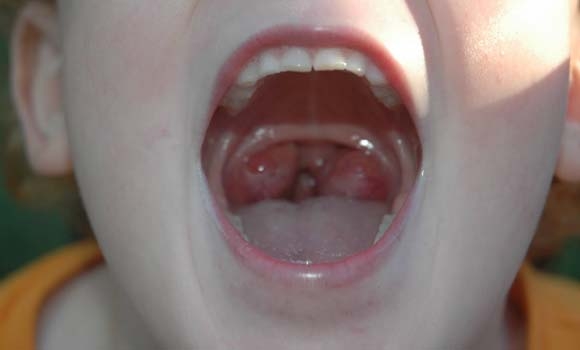 لابردنی لەوزەكان