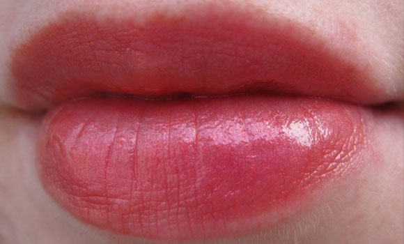 مەترسییەكانی نەشتەرگەری گەورەكردنی لێوەكان