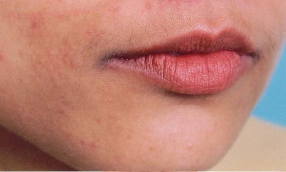 موودەردان و نەزۆكی