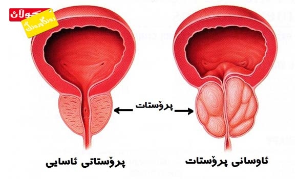 ئاوسانی پرۆستات