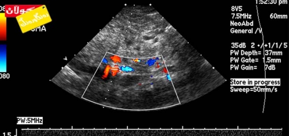 پشكنینی سۆناری دۆپلەر