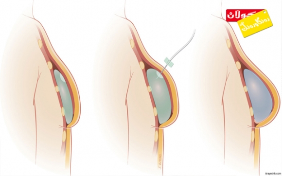 قەبارەی مەمك بە چییەوە بەندە؟