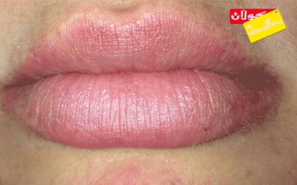 وشكبوونی پێستی دەوری دەم