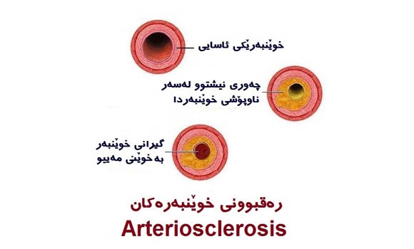 ڕەقبوونی خوێنبەرەكان