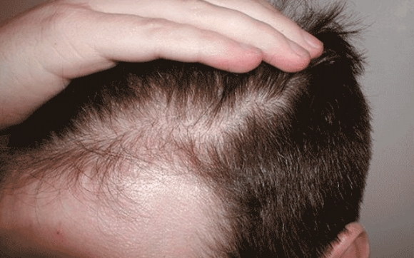 تێستۆستیرۆن هۆكاری سەرەكی قژڕووتانەوەی پیاوە نەك تەمەن