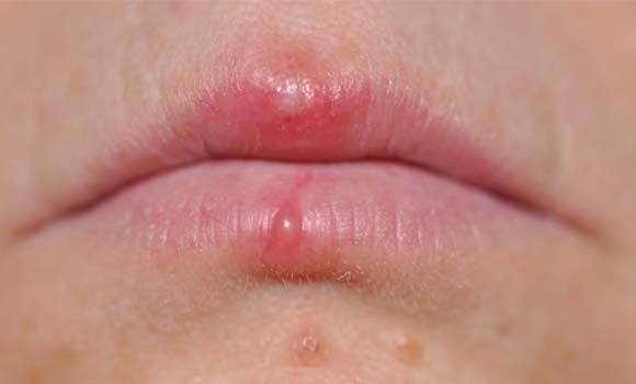 ترس و تامیسكە