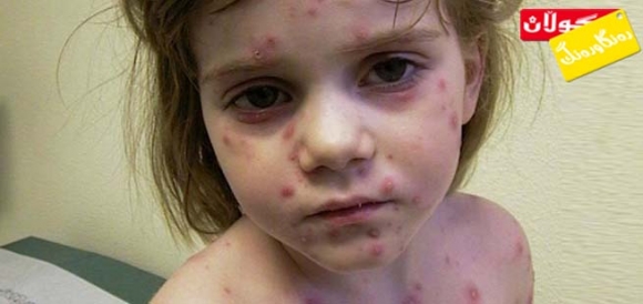 ڤایرۆسی ڤاریسێللا زوستەر، هۆكاری تووشبوونە بە مێكوتە