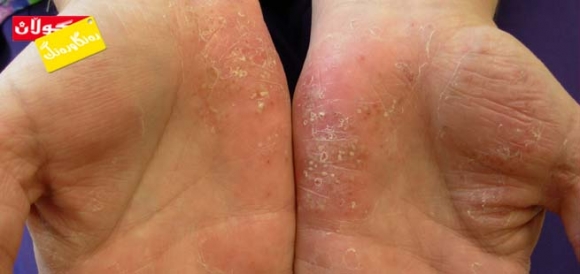 وروژێنەرەكانی نەخۆشيی سەدەف