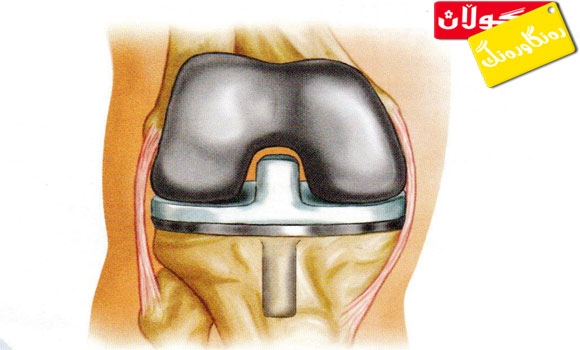 گۆڕینی جومگەی ئەژنۆ
