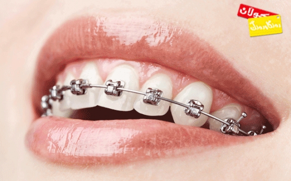 سوود و زیانەكانی تەوقی ددان