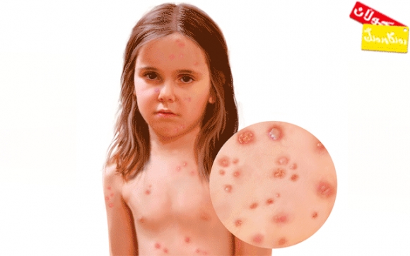 مێكوتە  دوچاری گەورانیش دەبێت