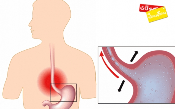 زیاتر لە نیوەی دانیشتووانی جیهان دوچاری بەكتریای كولبوونی گەدە بوونە