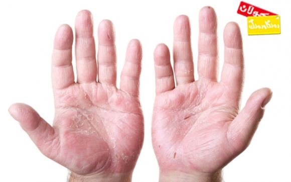 ئەكزیمای دەست