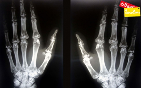 بۆ زانیاریت  - تیشكی سینی (X-ray)